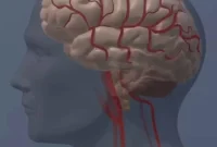 The Hidden Health Toll on Spouses of Stroke Survivors