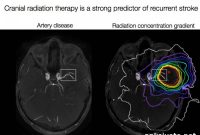 Recurrent Stroke Risk in Childhood Cancer Survivors
