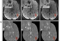 MRI Detects Microbleeds After TBI in Military Personnel
