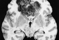 Gene Therapy Doubles Survival in Recurrent Glioblastoma