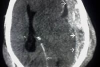 High Fructose Diet Slows Traumatic Brain Injury Recovery