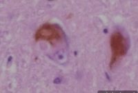 3-Minute Test Detects Common Hard-to-Diagnose Dementia