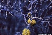 Immunotherapy for Alzheimer’s Disease