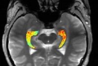 Glutamate Imaging Reveals Hidden Seizure Sites in Epilepsy