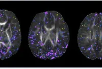 Low Maternal Iron in Pregnancy Impairs Infant Brain Development