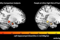 Increased Brain Blood Flow Linked to Psychosis Onset