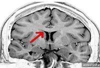 Aging Corpus Callosum Crosstalk Slows Reaction Time