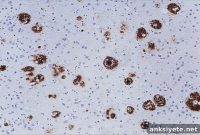 Alzheimer-Like Brain Changes After Dura Mater Transplant