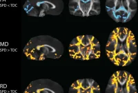 SPD Linked to Altered Brain Connectivity in Children
