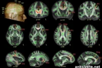 How Brain Structure Differs in Men With Autism