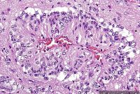 Scientists Find Genetic Mutation Driving Childhood Brain Cancer