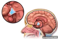 New Syndrome Linked to Obesity and Cognitive Disability