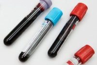 Blood Neuroprotective Protein Could Be an Alzheimer’s Biomarker