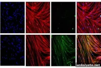 Promising Stem Cell Gene Therapy for Duchenne Muscular Dystrophy