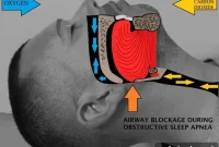 How Computational Tools Are Transforming Sleep Apnea Treatment