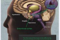 New Study Blocks Alzheimer’s Neuronal Death and Oxidative Stress