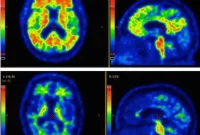 Alzheimer’s Protein Reveals Unexpected Roles in Disease