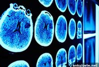 Vascular Brain Injury Detected in People in Their 40s