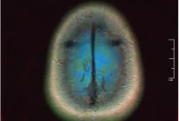 Chickenpox Linked to Reduced Brain Cancer Risk