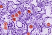 Study Finds Zika Virus Linked to New Brain Disorder