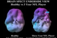 Low Cerebral Blood Flow Linked to Brain Damage in NFL Players