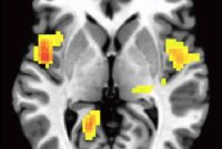 Predictable Brain Patterns in Socially Withdrawn Children