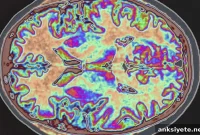 Mild Cognitive Impairment Often Goes Undetected by Screenings