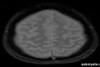 Push to Reclassify Traumatic Brain Injury as Chronic Disease