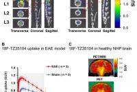 Detecting Neuroinflammation in MS: Imaging and Biomarkers