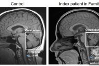 Gene Mutation Linked to Ataxia in Humans and Dogs