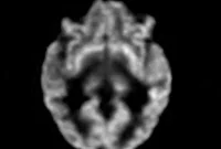 New Neuroimaging Tool Reveals Common Brain Disorders