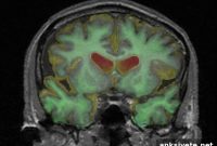 Designer Protein Advances Alzheimer’s Research
