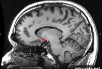 Brain Receptor Loss Tied to Low Activity in Postmenopausal Women