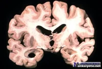 Low Late-Life Weight Linked to Higher Alzheimer’s Risk