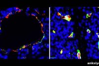 New Biomarker Linked to Chronic Brain Disease