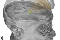 Ultrasound Therapy to Restart Brain Function After Coma