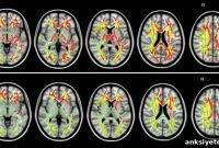 Study: Brain Traffic Jam Linked to Common Cognitive Disorder