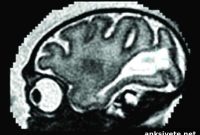 New Study Reveals How Zika Virus Impairs Fetal Brain Development