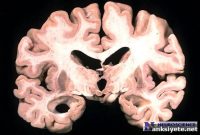 Toxic Nuclear Structures in Neurons Linked to Alzheimer’s Disease