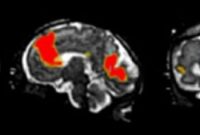 New Noninvasive Prenatal Scan Reveals Fetal Brain Activity