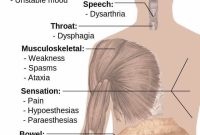 Multiple Sclerosis Drug Shows Promise in Reversing Disability