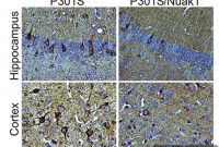 Novel Strategy Could Prevent Alzheimer’s Disease