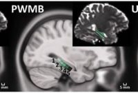 Persistent Seizures After Epilepsy Surgery: Causes Explained