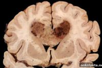 Patient Treated with Oncolytic Virus in Brain Tumor Trial
