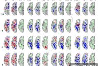 Autism Linked to Greater Brain Hemisphere Symmetry
