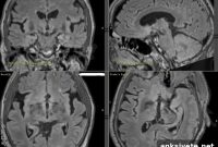 Emerging Patterns in Deep Brain Stimulation