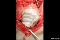 Soft Robotic Sleeve Helps Failing Hearts Beat Again