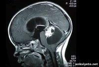 New Treatment Brings Hope to Children with Brain Tumors