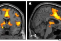 New Risk Factors for Anxiety Disorders Revealed by Study