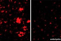 Vascular Changes Linked to Alzheimer’s Onset
